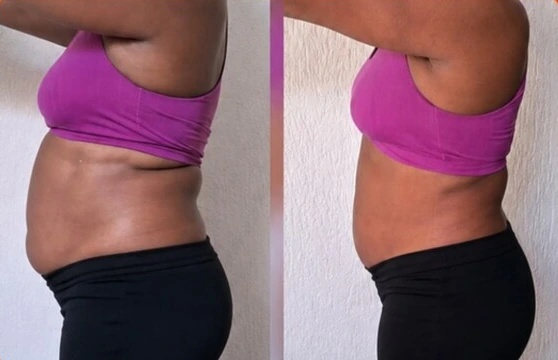Perfil da barriga antes e depois